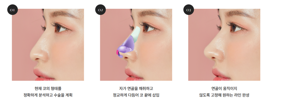 세련된 코끝 + 콧대라인, 바바성형외과의 트렌디 코성형 노하우 관련 이미지 8
