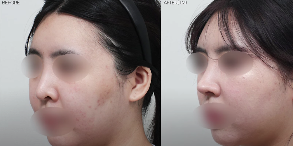 예쁜 코의 공통점은? 성형외과 원장이 알려주는 코 성형 성공하는 방법(리얼 후기 케이스) 관련 이미지 24