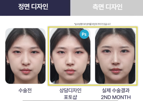 압구정 바바성형외과 코성형 &ndash; 정면&middot;측면 모두 고려한 코라인 설계 관련 이미지 18