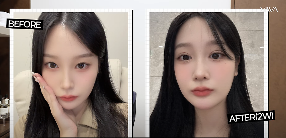 쌍꺼풀 재수술, 흉터 없이 가능할까? 관련 이미지 10