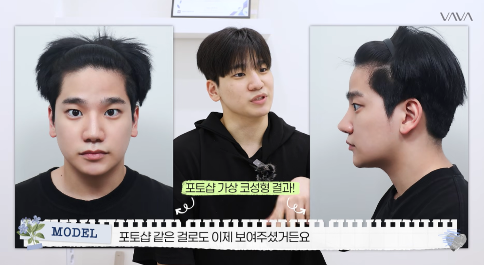 무보형물 직선라인 코성형으로 주먹코&middot;복코 개선｜압구정 바바성형외과 사례 관련 이미지 4