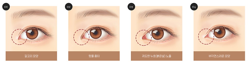 트임이 필요한 눈매와 트임 수술법 관련 이미지 11