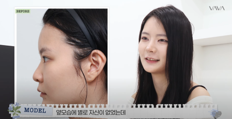 바바성형외과 복코&middot;매부리코&middot;휜코 동시 교정! 직반라인 코성형 리얼 후기 관련 이미지 14