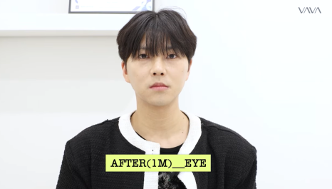 눈&middot;구축코 재수술 후기｜남자 눈코 재수술, 압구정 바바에서 달라진 이유 관련 이미지 2