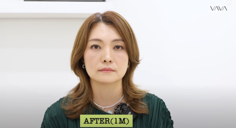 50대에도 자신감 가득 엄마의 두번째 리즈시절, 중년 눈성형&middot;하안검&middot;이마거상 리얼 후기 관련 이미지 2