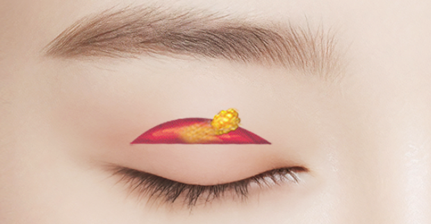 자연유착 VS 절개  어떤 기준으로 선택해야 할까? 관련 이미지 5