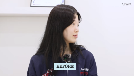 압구정 바바성형외과 자가늑 코성형 후기｜복코&middot;매부리코 교정 한달차 변화 관련 이미지 22