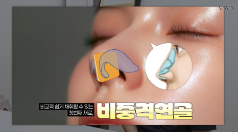 첫 코 성형, 언제&middot;어떻게 해야 할지 기준 정리해드립니다 관련 이미지 18