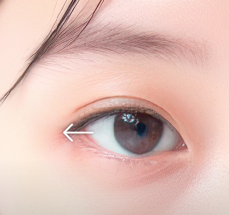 쌍수만으로 충분할까? 윗트임 병행이 필요한 경우 관련 이미지 4