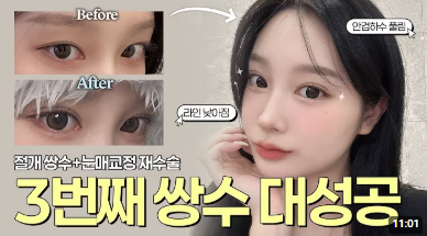 바바성형외과 절개 쌍수 절개 눈매교정 쌍꺼풀  재수술  사례 관련 이미지 1