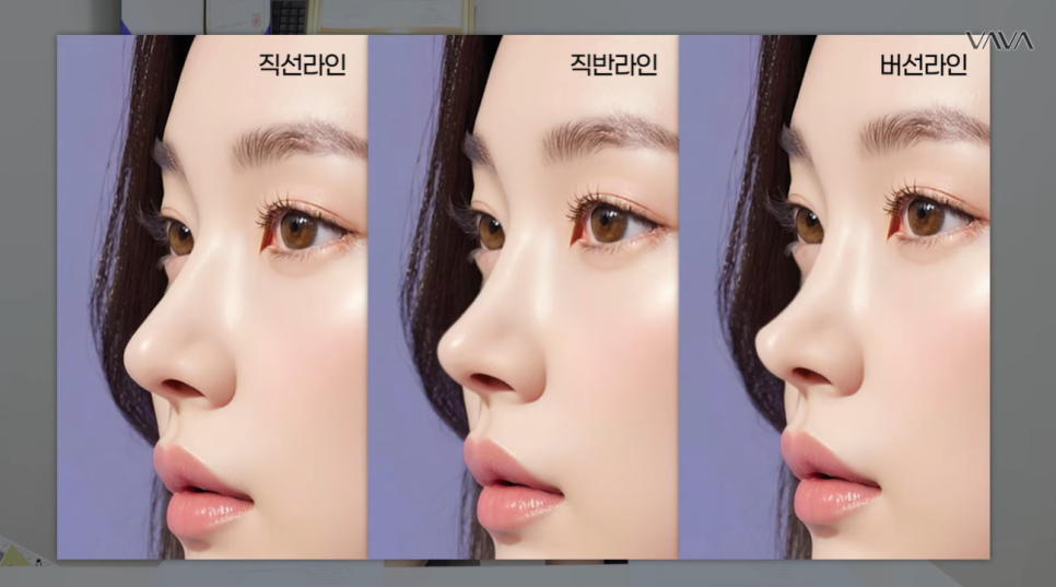 첫 코 성형, 언제&middot;어떻게 해야 할지 기준 정리해드립니다 관련 이미지 5