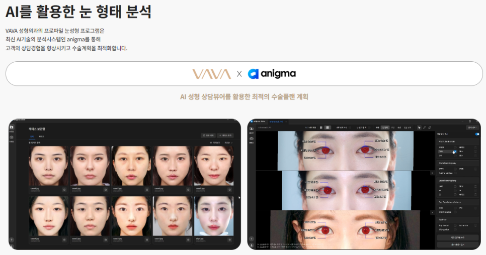 눈밑지방재배치 이거 모르고 하면 티 납니다 ㅣ  눈밑지방재배치 잘 되는 기준 관련 이미지 3