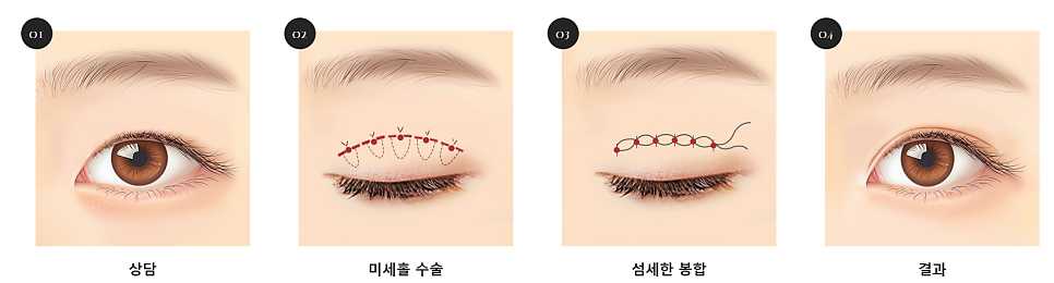 쌍꺼풀 수술 종류 비절개 vs 절개 vs 부분 절개 관련 이미지 4