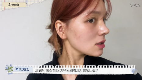 보형물 없이 선명하게｜바바성형외과 무보형물 매부리코 교정 리얼 후기 관련 이미지 15