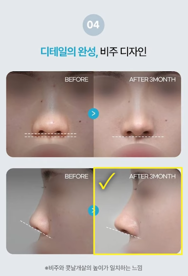 압구정 바바성형외과 코성형 &ndash; 정면&middot;측면 모두 고려한 코라인 설계 관련 이미지 13