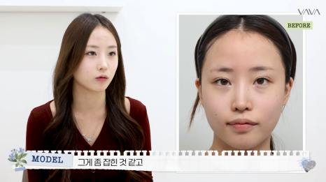 코재수술로 인상까지 달라질 수 있을까?｜바바성형외과 직반라인 코재수술 후기 관련 이미지 22
