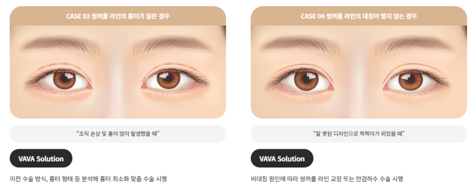 Revision Double Eyelid Surgery May Not Be Just a Line Issue | When Revision Eyelid Surgery Is Needed at Baba Plastic Surgery image 3