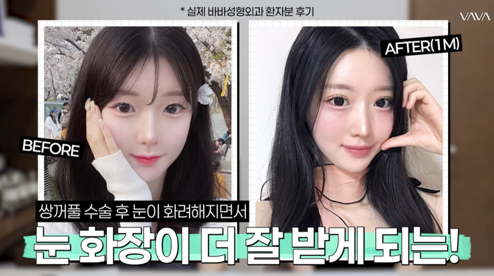 쌍꺼풀 수술 짧은 회복기 가능? 종류별 차이 완전 정리 관련 이미지 17