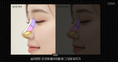 코성형 재료 총정리｜실리콘 부작용&middot;자가늑연골 와핑&middot;귀연골 흡수까지 (콧대 코끝 비교) 관련 이미지 4
