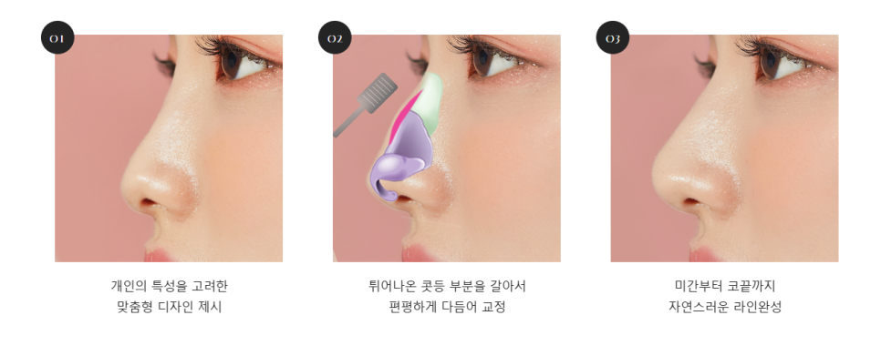 최준희 코 재수술 눈 재수술 성형 분석 관련 이미지 11