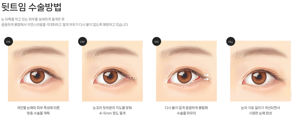 Concerned About Eyes That Look Narrow and Constricted? | When a Lateral Canthoplasty & Lower Canthoplasty May Be Needed at Baba Plastic Surgery Clinic image 3