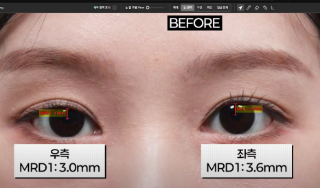 쌍꺼풀 재수술, 흉터 없이 가능할까? 관련 이미지 8