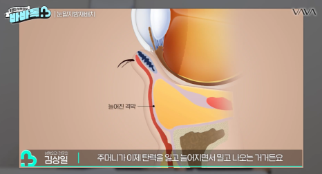 눈밑지방재배치 vs 하안검 vs 필러, 나는 어떤 케이스일까? | 압구정 바바성형외과에서 알려드립니다 관련 이미지 13