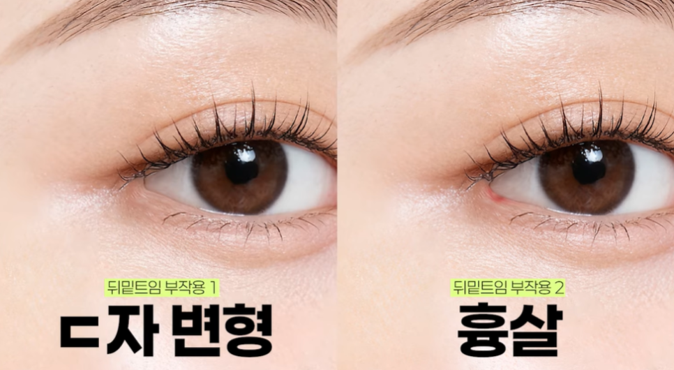 뒤밑트임 수술, 잘 되는 눈 따로 있습니다｜추천 대상&middot;부작용&middot;재유착 정리 관련 이미지 20