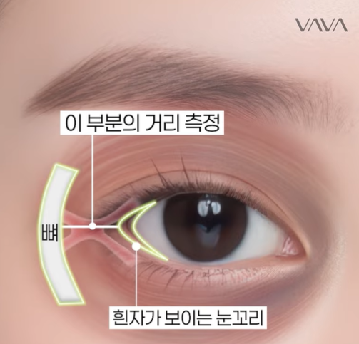 뒤밑트임 수술, 잘 되는 눈 따로 있습니다｜추천 대상&middot;부작용&middot;재유착 정리 관련 이미지 17