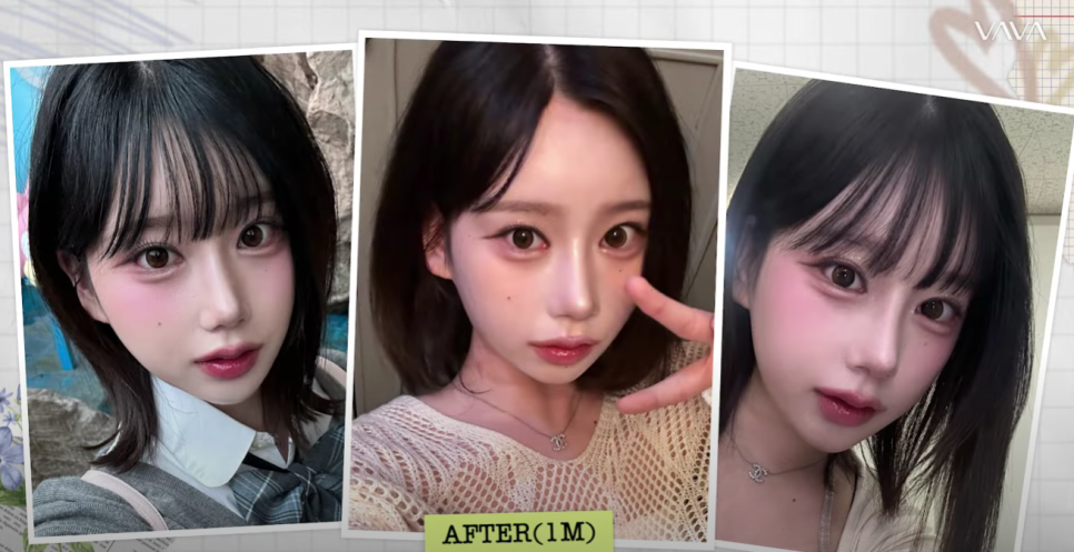 바바성형외과 눈&middot;코 성형 한 달 차 리얼 케이스 (윈터, 카리나 코) 관련 이미지 17