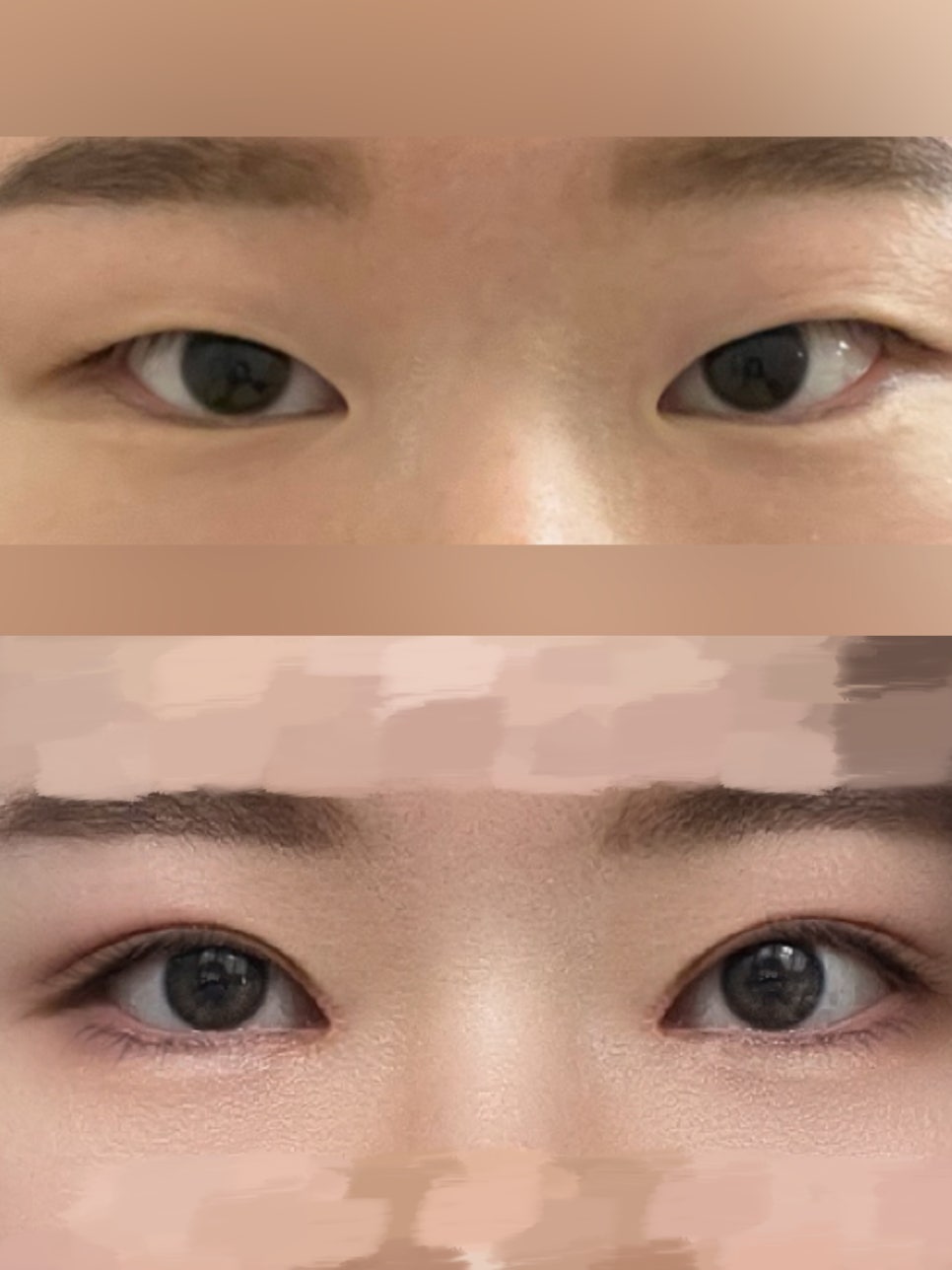 둔해보이는 눈매 무쌍 수술 전후 결과 알아보기 관련 이미지 4