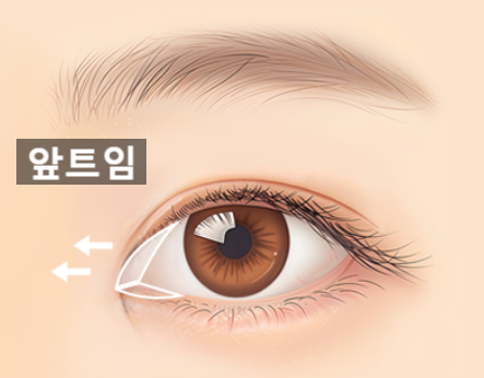 자연유착 VS 절개  어떤 기준으로 선택해야 할까? 관련 이미지 20