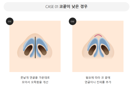 입체적이고 균형 잡힌 코 라인을 위한 자가연골 코 성형(비중격, 귀연골, 늑연골) 관련 이미지 10