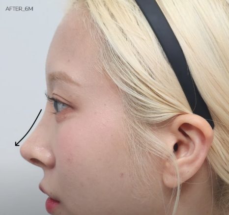 코재수술 원인, 과연 코끝처짐만이 문제일까? 가장 이상적인 라인 알려드립니다 관련 이미지 24