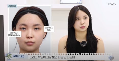 쌍수 재수술 성공기 ｜ 졸려보이는 눈 세미아웃으로 예뻐진 리얼 Before & After 관련 이미지 16