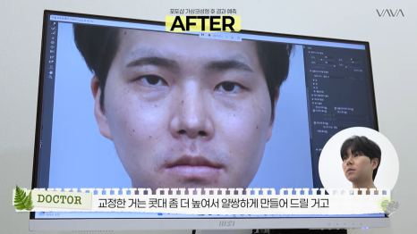 눈&middot;구축코 재수술 후기｜남자 눈코 재수술, 압구정 바바에서 달라진 이유 관련 이미지 13