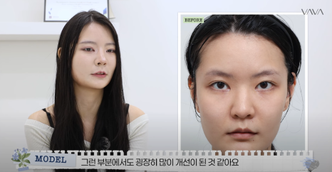 바바성형외과 복코&middot;매부리코&middot;휜코 동시 교정! 직반라인 코성형 리얼 후기 관련 이미지 15