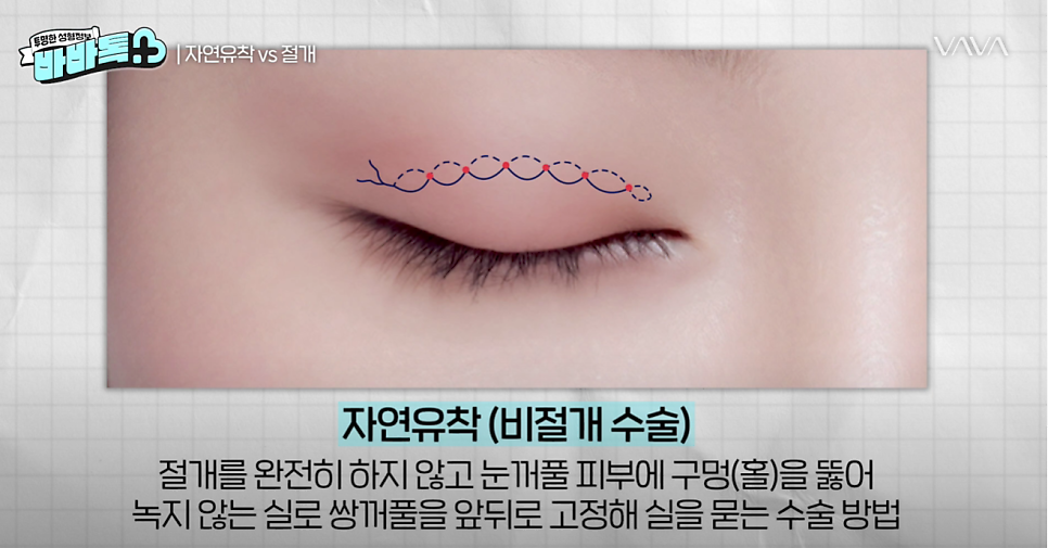 나에게 맞는 쌍꺼풀 수술법 총정리 : 절개, 부분절개, 매몰법까지 관련 이미지 2