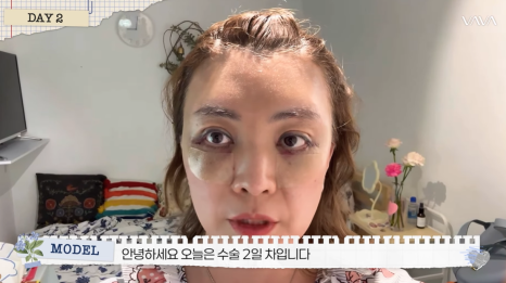 50대에도 자신감 가득 엄마의 두번째 리즈시절, 중년 눈성형&middot;하안검&middot;이마거상 리얼 후기 관련 이미지 8