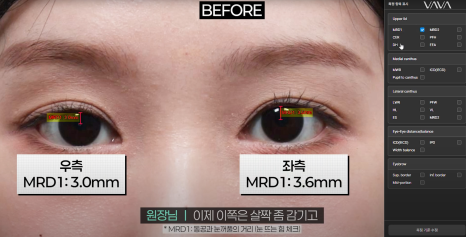 바바성형외과 절개 쌍수 절개 눈매교정 쌍꺼풀  재수술  사례 관련 이미지 7