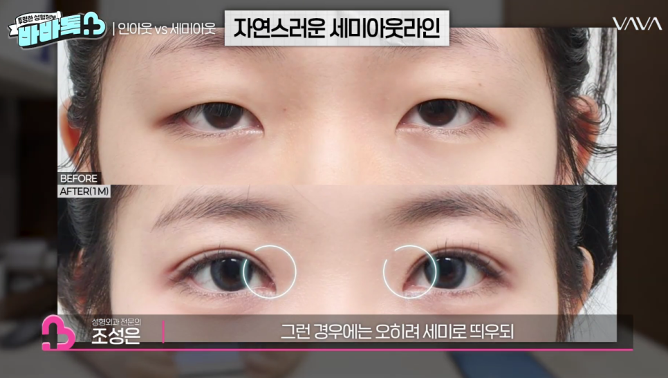 세미아웃라인 인아웃라인 쌍꺼풀 잘 받는 타입 (몽고주름) 관련 이미지 16