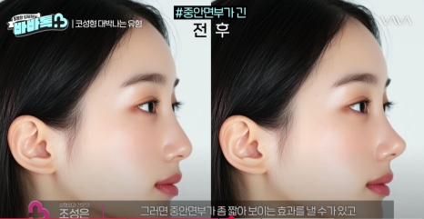 코 수술 성공을 위한 유형과 조건 확인 해보기 관련 이미지 11