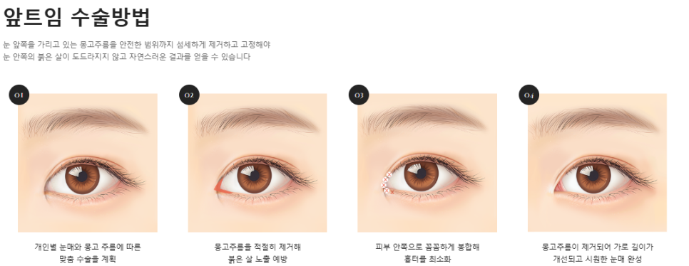 트임이 필요한 눈매와 트임 수술법 관련 이미지 3