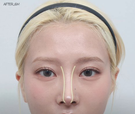 코재수술 원인, 과연 코끝처짐만이 문제일까? 가장 이상적인 라인 알려드립니다 관련 이미지 21