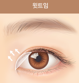 쌍꺼풀 수술만으로 충분할까? 눈 트임이 필요한 경우 관련 이미지 4