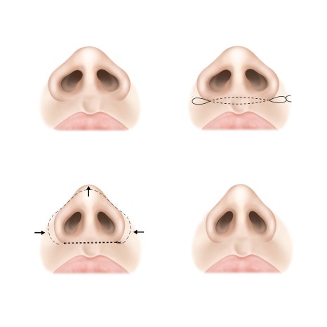 코 성형 후 붓기 기간과 붓기 관리방법 관련 이미지 3