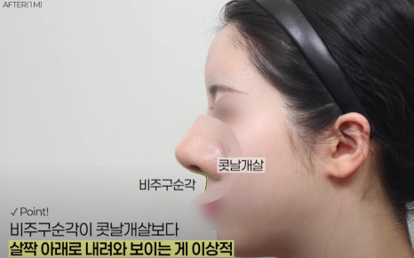 예쁜 코의 공통점은? 성형외과 원장이 알려주는 코 성형 성공하는 방법(리얼 후기 케이스) 관련 이미지 20