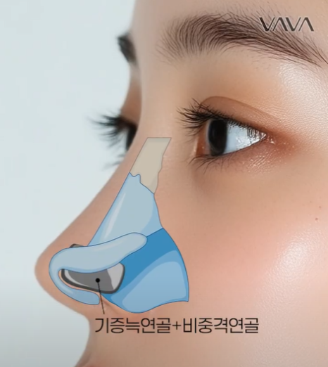 압구정 바바성형외과 | 코성형의 핵심, 비주의 중요성과 교정 방법 관련 이미지 12