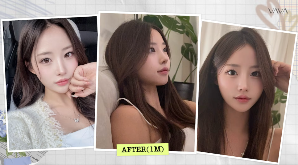 코재수술로 인상까지 달라질 수 있을까?｜바바성형외과 직반라인 코재수술 후기 관련 이미지 24