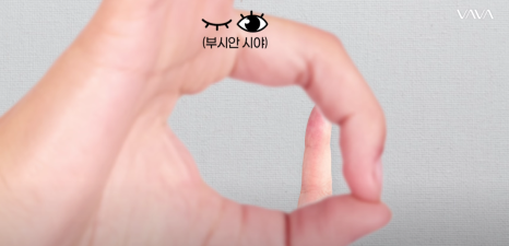 쌍수 후 생겨버린 짝눈 교정 눈의 균형을 맞추는 섬세한 방식 관련 이미지 26